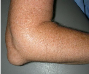 Image shows a elbow that has Olecranon Bursitis